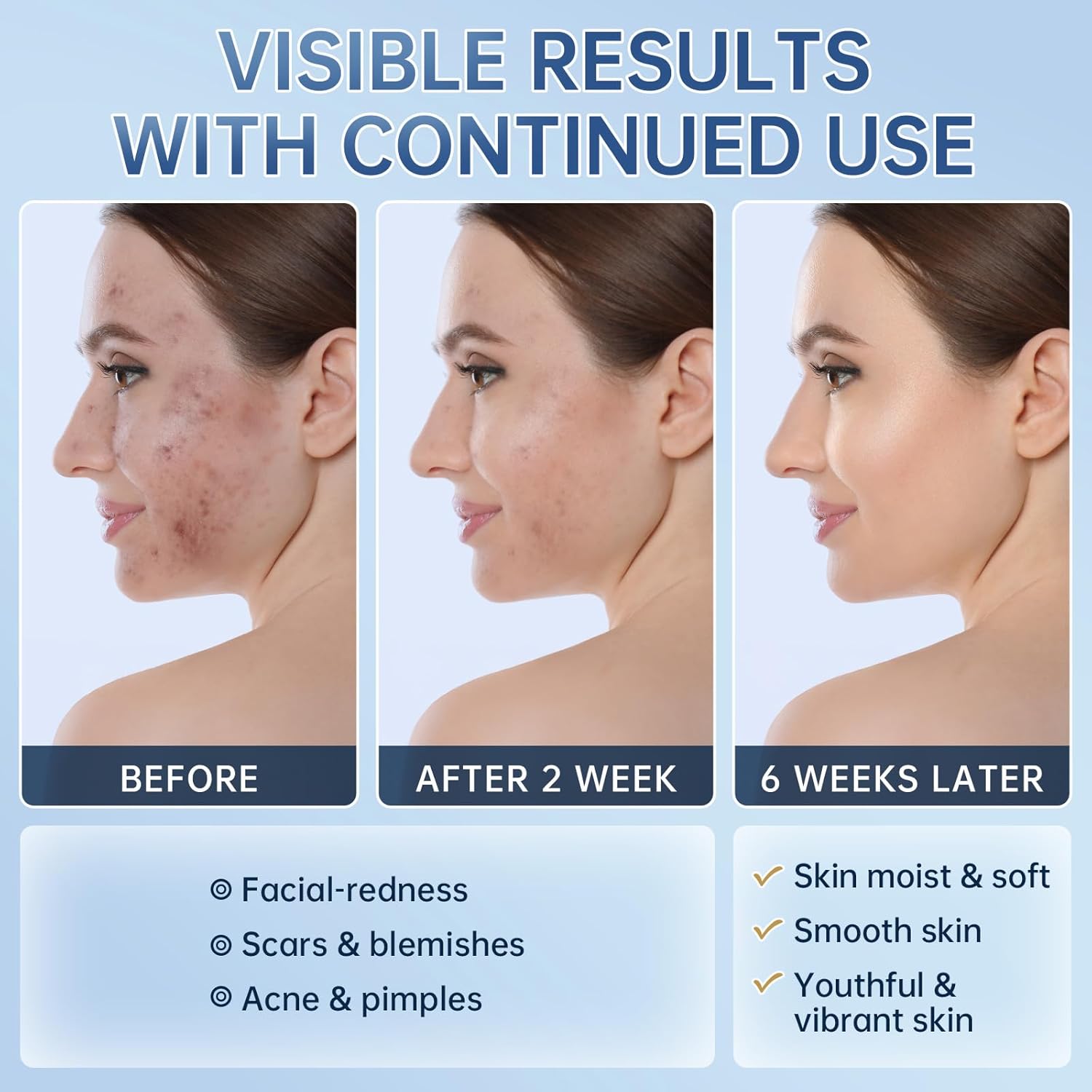 Azelaic Acid 14% Acne Cream for Redness Relief, Dark Spots, Facial Serum with Niacinamide & Vitamin C Prevent Acne Breakouts, Azelaic Acid Serum for Balance Excess Sebum & Soothe Irritation, 1 Oz.